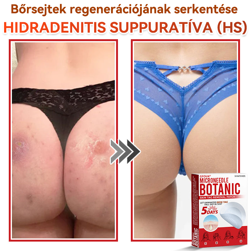 đGFOUKÂź MikrotƱs növĂ©nyi bĆrkinövĂ©s eltĂĄvolĂtĂł tapasz