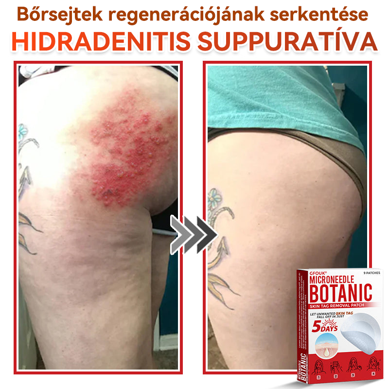 🔥 GFOUK® Mikrotűs növényi bőrkinövés eltávolító tapasz