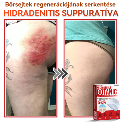 🏆🏆GFOUK® Mikrotűs növényi bőrkinövés eltávolító tapasz
