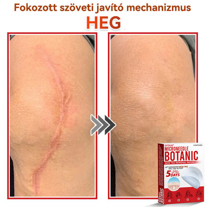 🔥 GFOUK® Mikrotűs növényi bőrkinövés eltávolító tapasz