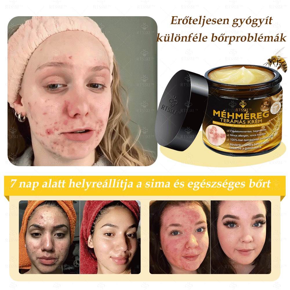 🐝🌿Hivatalos Bolt: 🏆RTSSKE™ Méh Méreg Bőrápoló Krém