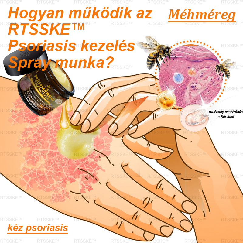 匈牙利🌿🌿RTSSKE™ Méhméreg Haladó Psoriasis Kezelő Krém (👨‍⚕Orvos Által Ajánlott)