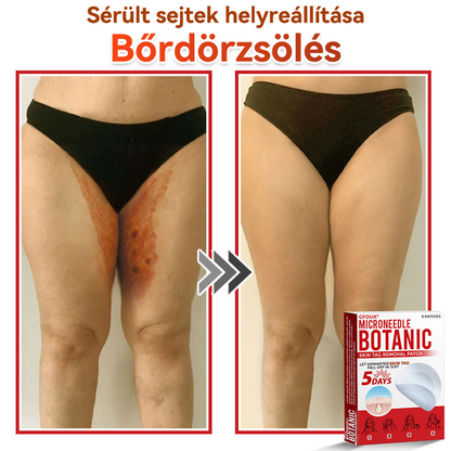 🏆🏆GFOUK® Mikrotűs növényi bőrkinövés eltávolító tapasz