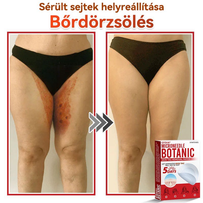 🔥 GFOUK® Mikrotűs növényi bőrkinövés eltávolító tapasz