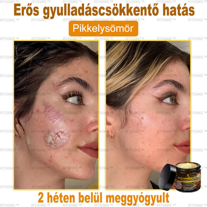 匈牙利🎖️ RTSSKE™ Méhméreg Teljeskörű Bőrápoló Krém 🇺🇸 Bőrgyógyászok Ajánlják