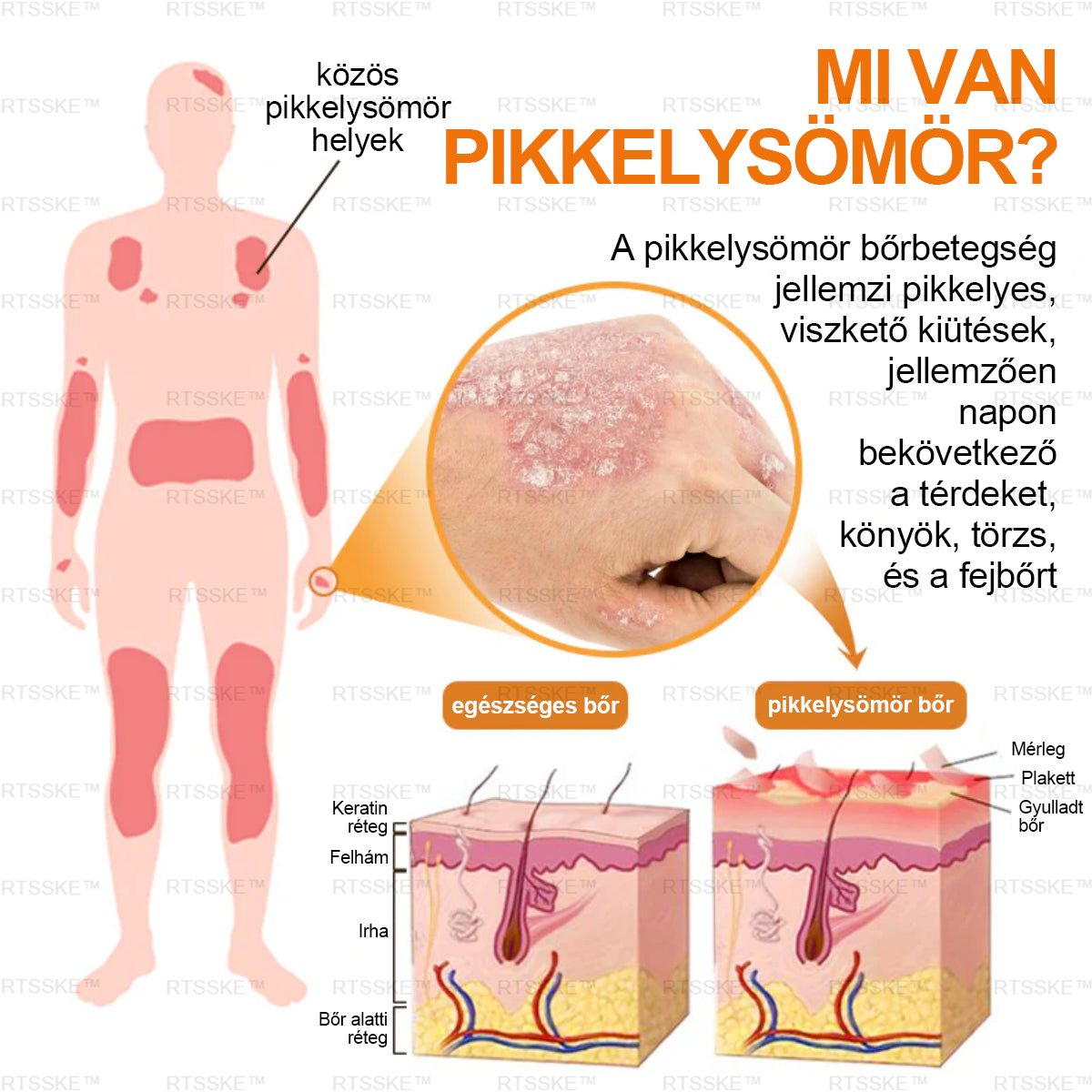匈牙利🌿🌿RTSSKE™ Méhméreg Haladó Psoriasis Kezelő Krém (👨‍⚕Orvos Által Ajánlott)