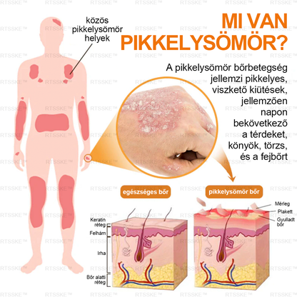 匈牙利🌿🌿RTSSKE™ Méhméreg Haladó Psoriasis Kezelő Krém (👨‍⚕Orvos Által Ajánlott)