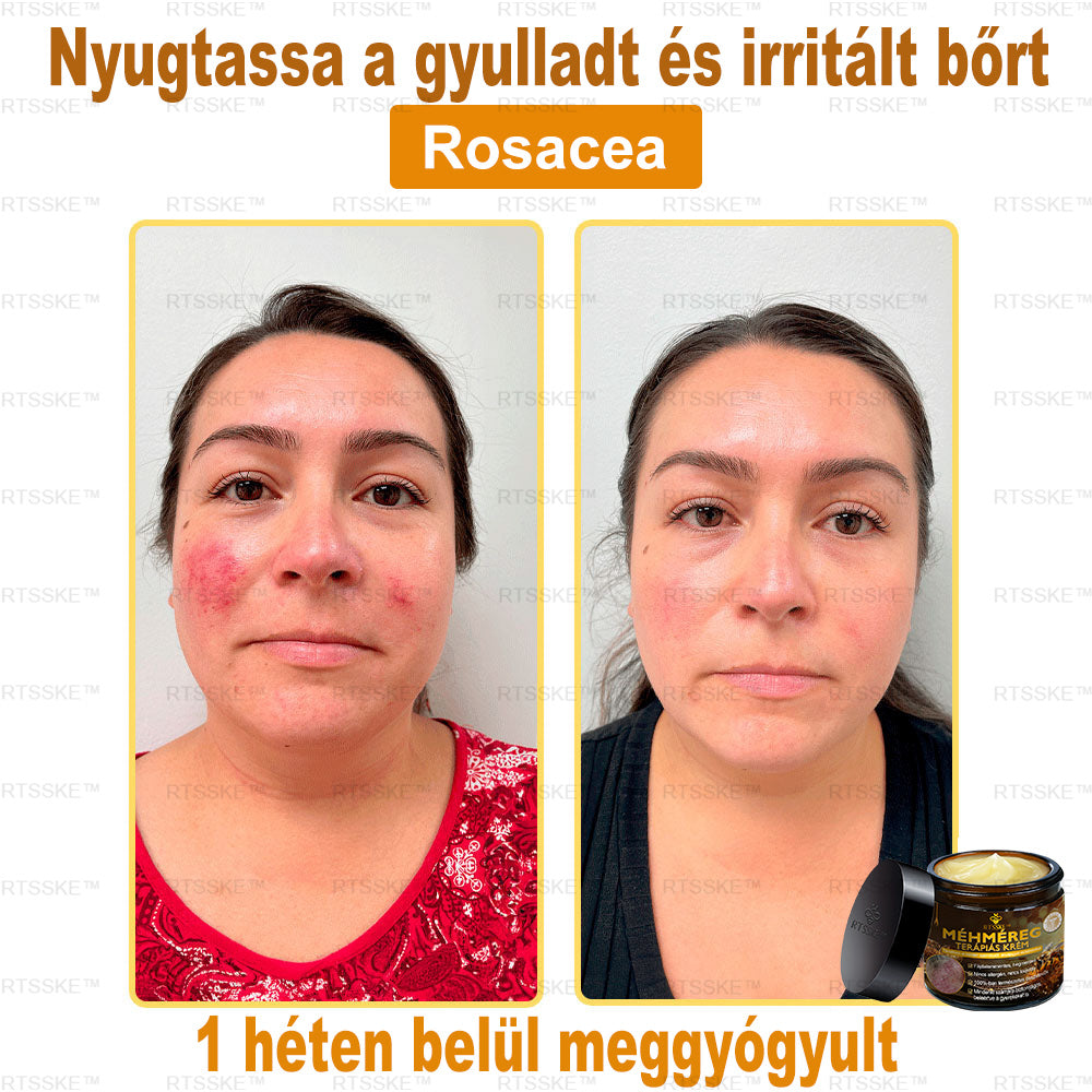 匈牙利🎖️ RTSSKE™ Méhméreg Teljeskörű Bőrápoló Krém 🇺🇸 Bőrgyógyászok Ajánlják