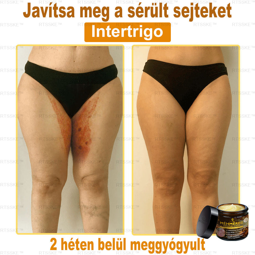 匈牙利🎖️ RTSSKE™ Méhméreg Teljeskörű Bőrápoló Krém 🇺🇸 Bőrgyógyászok Ajánlják