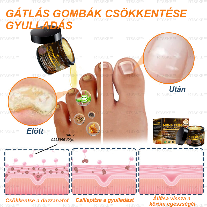 匈牙利🌿🌿RTSSKE™ Méhméreg Haladó Psoriasis Kezelő Krém (👨‍⚕Orvos Által Ajánlott)