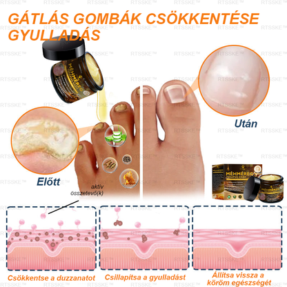 匈牙利🌿🌿RTSSKE™ Méhméreg Haladó Psoriasis Kezelő Krém (👨‍⚕Orvos Által Ajánlott)
