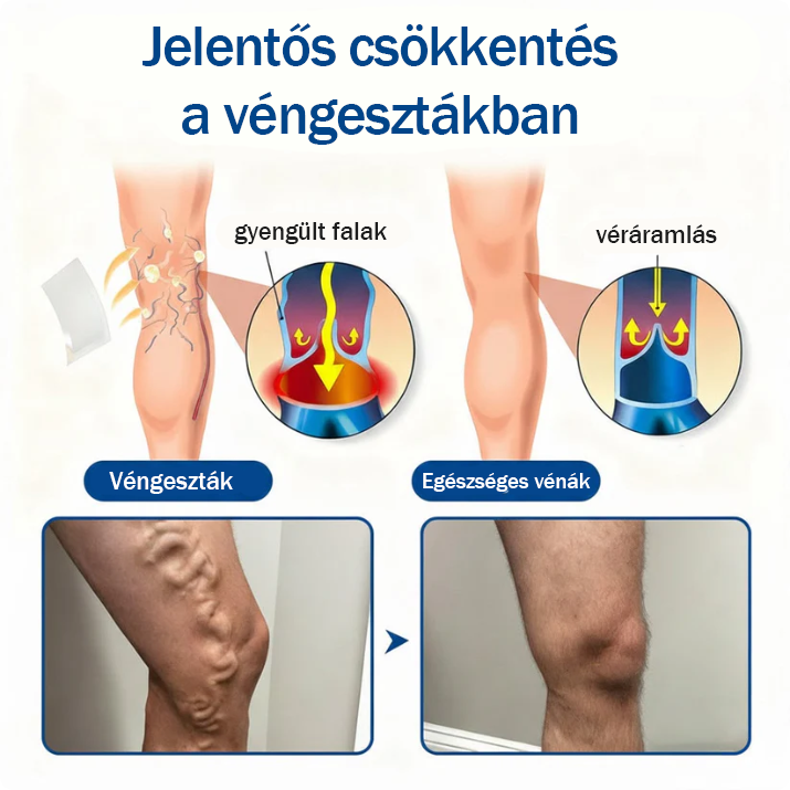 🇭🇺👨‍⚕️✅TAILEDEN® VeinEase Mikrotűs Kezelő Tapasz⚡Azonnali Megkönnyebbülés, Hosszú Távú Eredmények