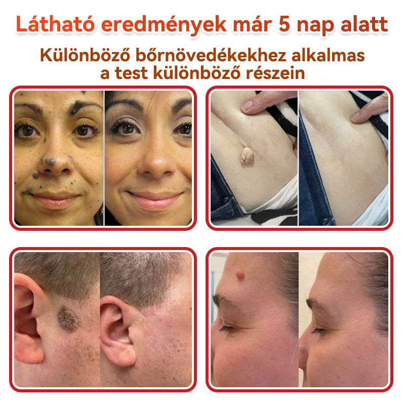 🏆🏆GFOUK® Mikrotűs növényi bőrkinövés eltávolító tapasz