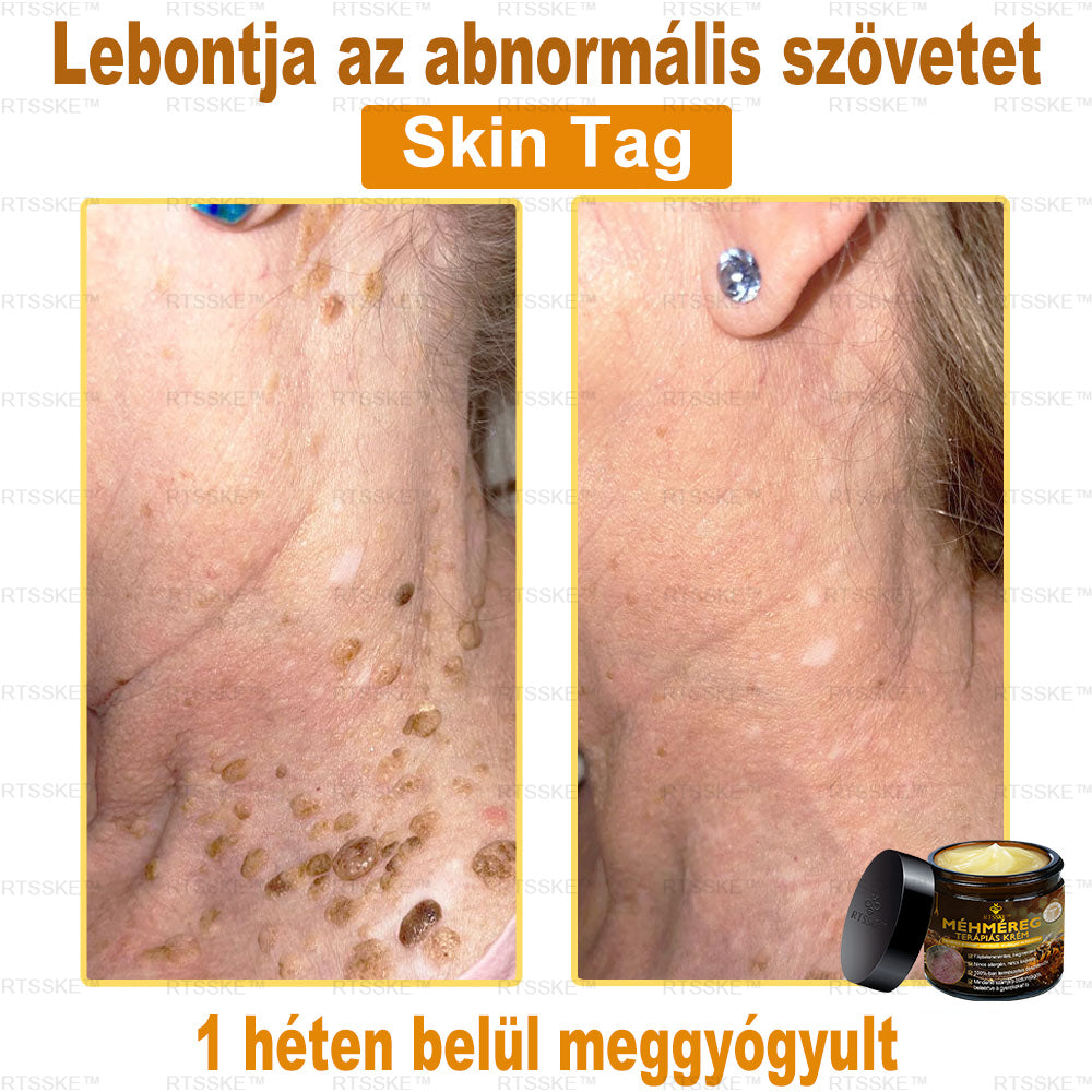 匈牙利🎖️ RTSSKE™ Méhméreg Teljeskörű Bőrápoló Krém 🇺🇸 Bőrgyógyászok Ajánlják