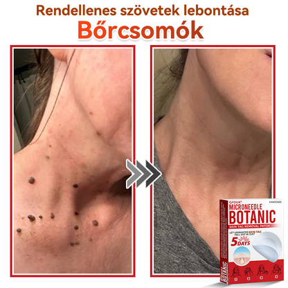 🔥 GFOUK® Mikrotűs növényi bőrkinövés eltávolító tapasz