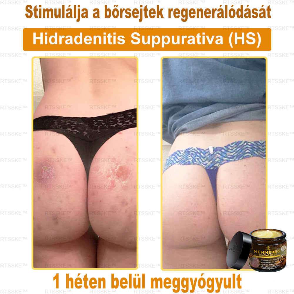 匈牙利🎖️ RTSSKE™ Méhméreg Teljeskörű Bőrápoló Krém 🇺🇸 Bőrgyógyászok Ajánlják