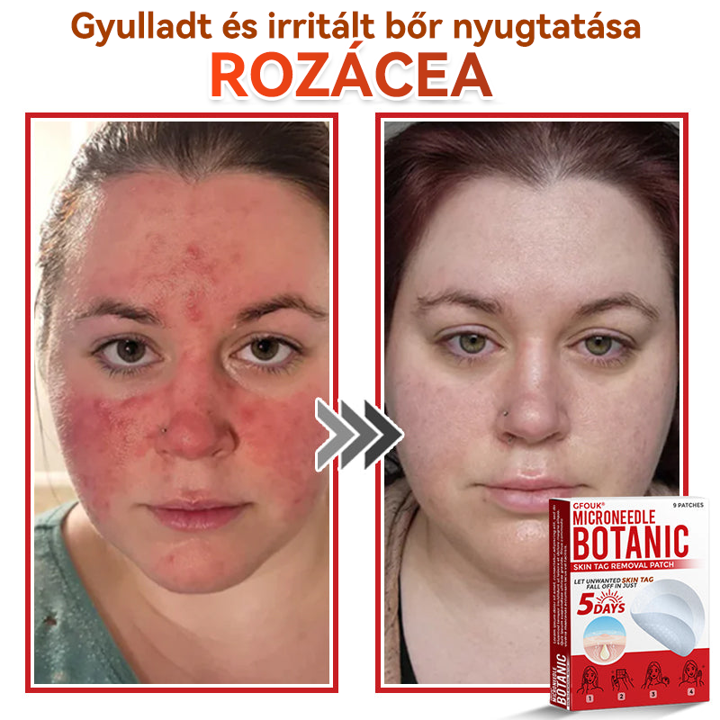 🏆🏆GFOUK® Mikrotűs növényi bőrkinövés eltávolító tapasz