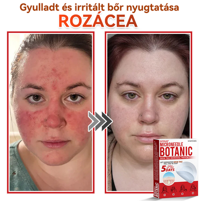 🔥🔥GFOUK® Mikrotűs növényi bőrkinövés eltávolító tapasz
