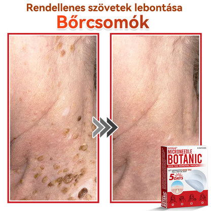🏆🏆GFOUK® Mikrotűs növényi bőrkinövés eltávolító tapasz