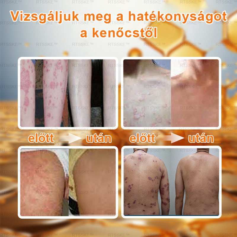 匈牙利🌿🌿RTSSKE™ Méhméreg Haladó Psoriasis Kezelő Krém (👨‍⚕Orvos Által Ajánlott)