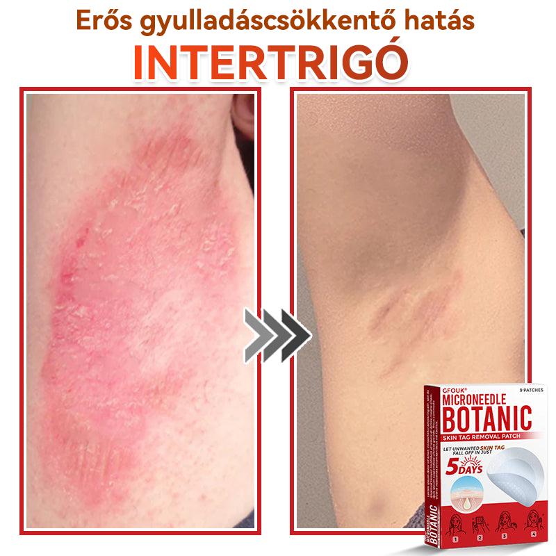 🔥🔥GFOUK® Mikrotűs növényi bőrkinövés eltávolító tapasz